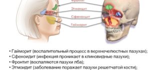 Двусторонний верхнечелюстной синусит, этмоидит, сфеноидит