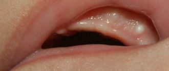 На десне белый прыщ