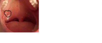 На небной дужке маленький прощупываемый шарик