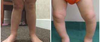 Варус и вальгус стопы