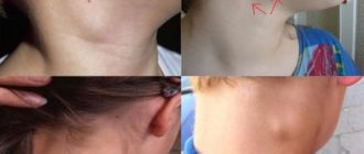 Долгое время увеличен один лимфоузел на шее