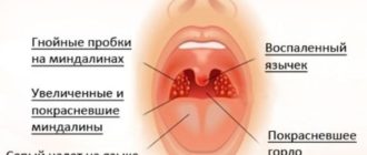 Налет на миндалинах, температура 7 дней