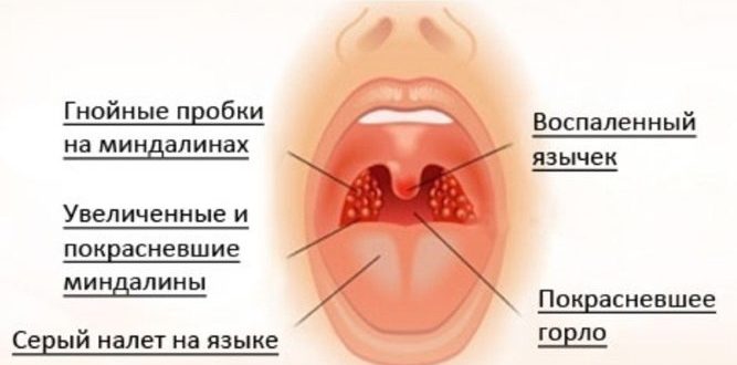 Налет на миндалинах, температура 7 дней