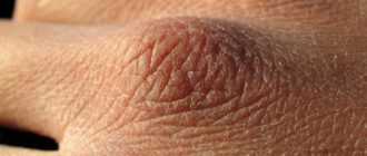 Что за цыпки на ногах?