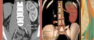 Единственная правая почка