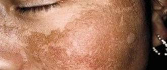 Чернеет кожа