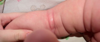 Что это может быть у ребенка под кожицей на писюне?