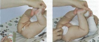 Выраженные синехии у ребенка 5 лет