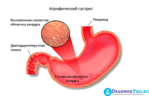 Что принимать при гэрб, имея атрофический гастрит