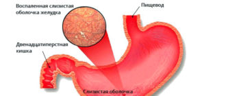 Что принимать при гэрб, имея атрофический гастрит