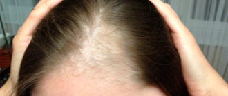 Выпадение волос после родов