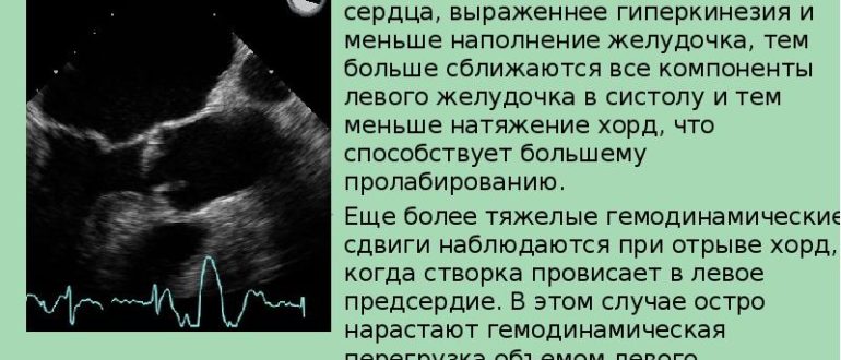 Что значит гиперкинез сердца?