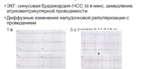 Диффузное нарушение процесса реполяризации и синусовый ритм