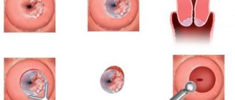 Воспаление эрозии шейки матки