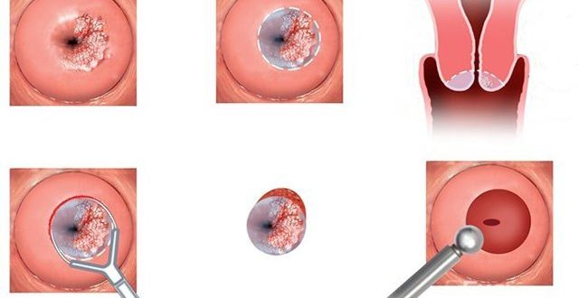Воспаление эрозии шейки матки