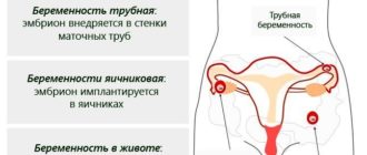 Внематочная беременность или гормональный сбой