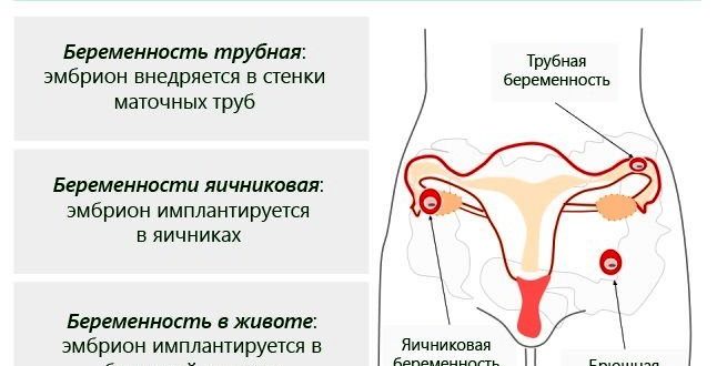 Правый Яичник Где Находится У Женщин Фото