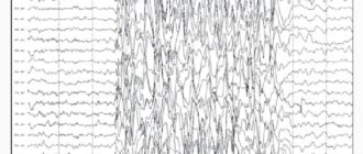 Эпилепсия без изменений на ээг