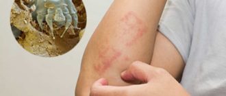 Чесотка покалывания, ощущения как «стекловата»