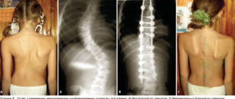 Двусторонний титановый дистрактор на позвоночнике