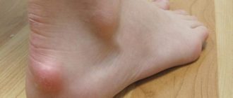 Мелкие шишечки на пятках