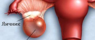Межменструальное кровотечение, киста яичника