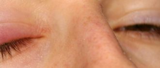 Чешутся глаза, отеки, гной