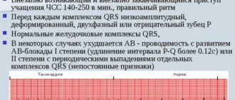 Внезапная тахикардия