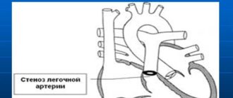 ВПС стеноз легочной артерии