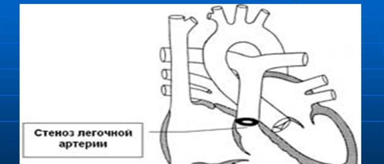 ВПС стеноз легочной артерии