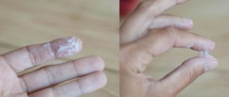 Выделения при логесте