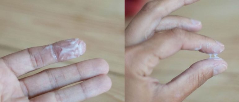 Выделения при логесте