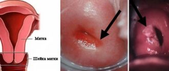 Молочница после биопсии