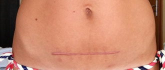 Можно ли в солярий если шов после операции красный