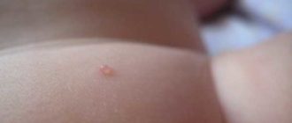 Водяной прыщик у ребёнка на шее