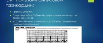 Экг с нагрузкой, синусовая тахикардия 118
