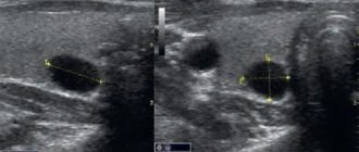 УЗИ показало узел на щитовидной железе