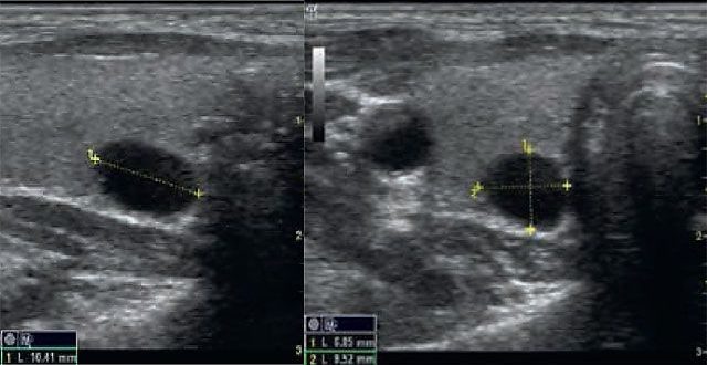 УЗИ показало узел на щитовидной железе