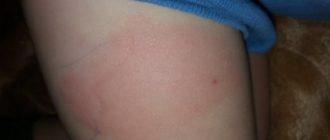 Воспалилась прививка