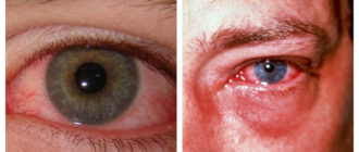 Что делать если попала сварка в глаза??