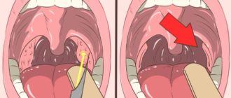 Во рту на миндалине сильный нарост достает до язычка