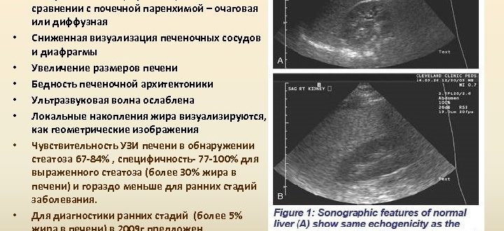 Диффузные изм енения паренхимы печени по типу жирового гепатоза