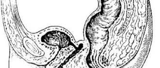 Влагалищно прямокишечный свищ