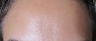 Кожа на лбу