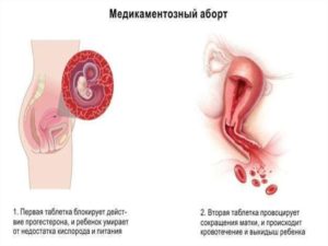 Чи можна завагітніти після першого аборту?