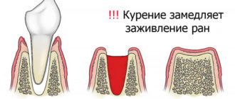 Можно ли курить при лечении флюса