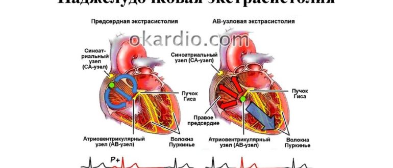 Наджелудочковая экстрасистолия у ребенка