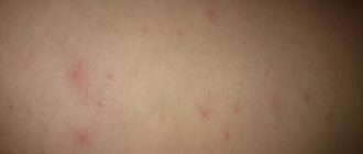 Вскакивают прыщики и чешутся