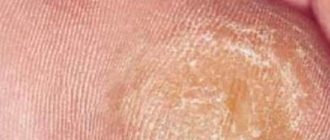 Мозоль на крайней плоти