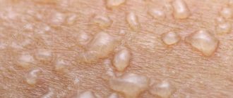 Водянистые прыщи